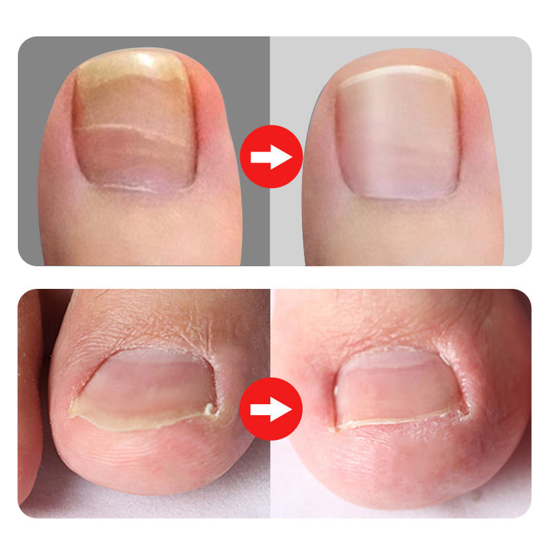 Professionell nagelklippare för inåtväxande tånaglar, 7 delar